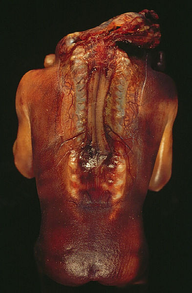 Failed neural tube closure in spine and head regions 